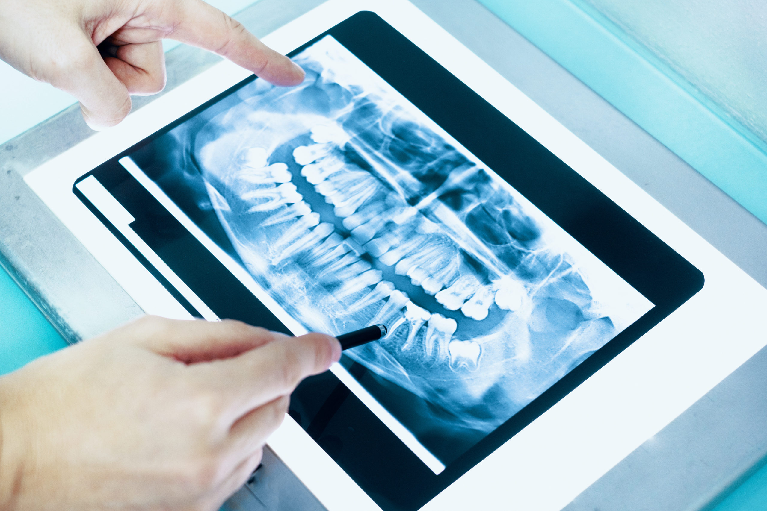 Digital X-Rays
