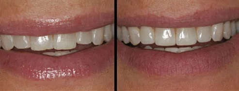 Enamel Reshaping before and after — Dr. Patel Dentistry Ajax