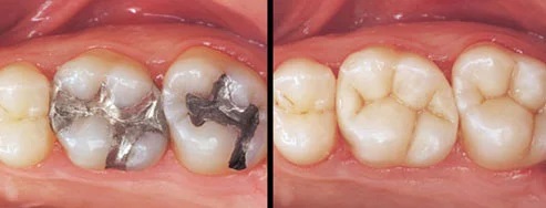 Tooth-Coloured Fillings before and after — Dr. Patel Dentistry Ajax
