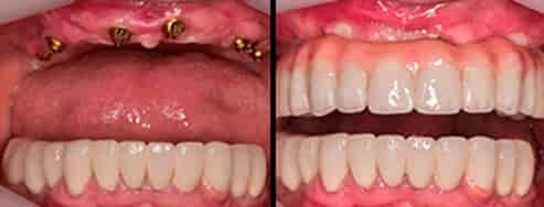Before After dental implant in Ajax images