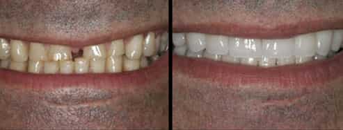 Before after dental veneer in Ajax images