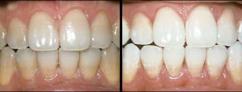 Before After teeth whitening in Ajax images